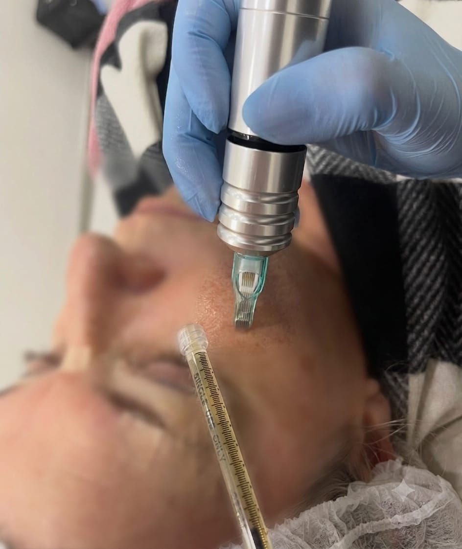 Aplicação do microagulhamento com drug delivery