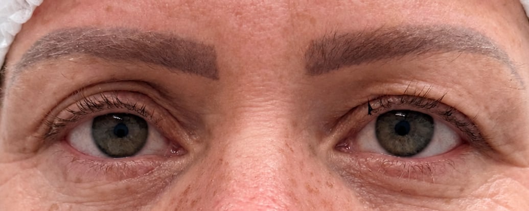 Antes — Caso 1 — blefaroplastia superior