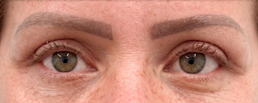 Depois — Caso 1 — blefaroplastia superior