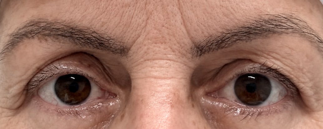 Antes — Caso 2 — blefaroplastia superior