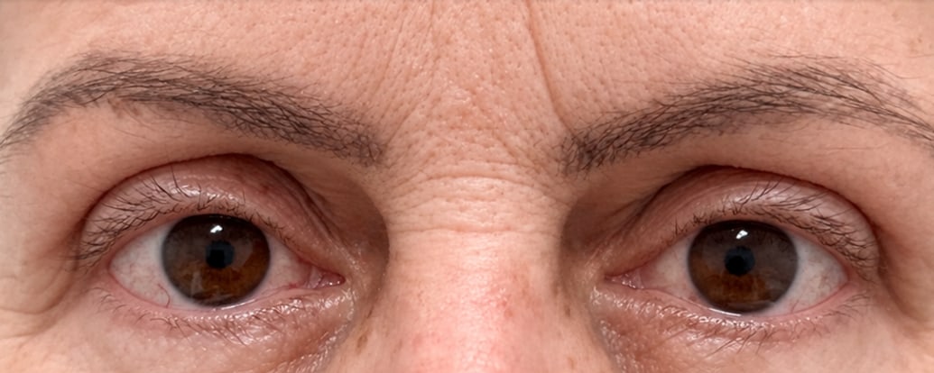 Depois — Caso 2 — blefaroplastia superior