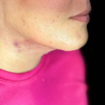 Depois — Caso 1 — lipoescultura de papada, vista de perfil